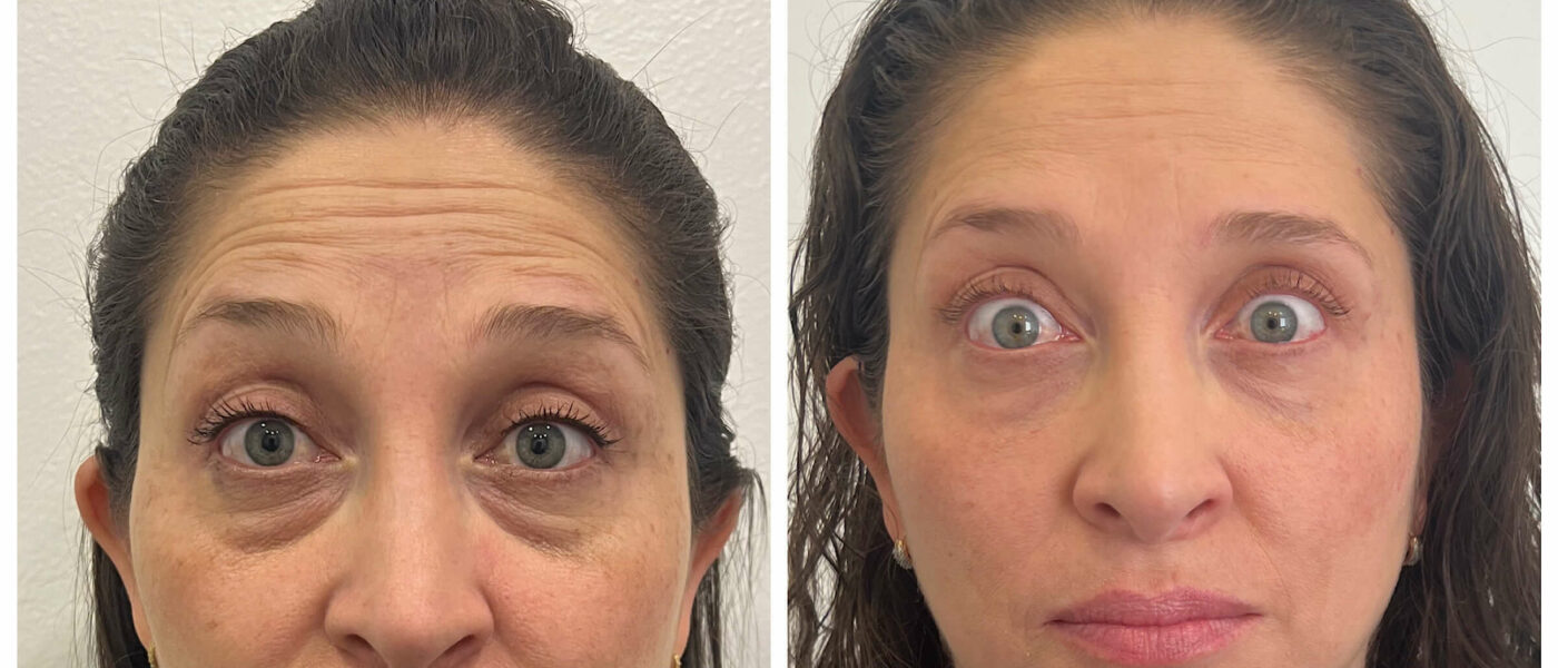 ¿Cuándo es hora de iniciar botox?